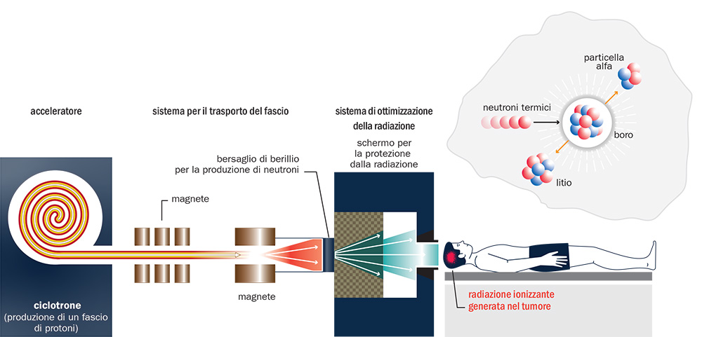 Componenti di un sistema per l’implementazione clinica della boron neutron capture therapy (BNCT)