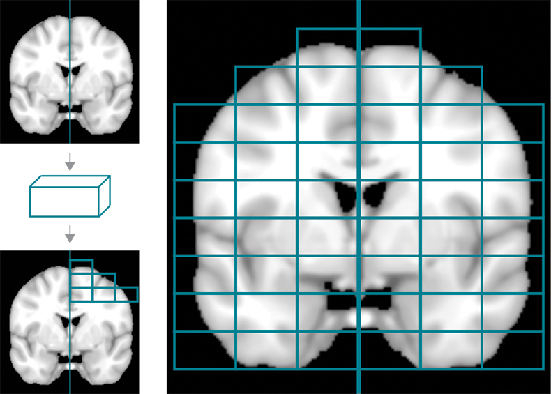 Scansioni cerebrali ottenute con la risonanza magnetica (MRI)